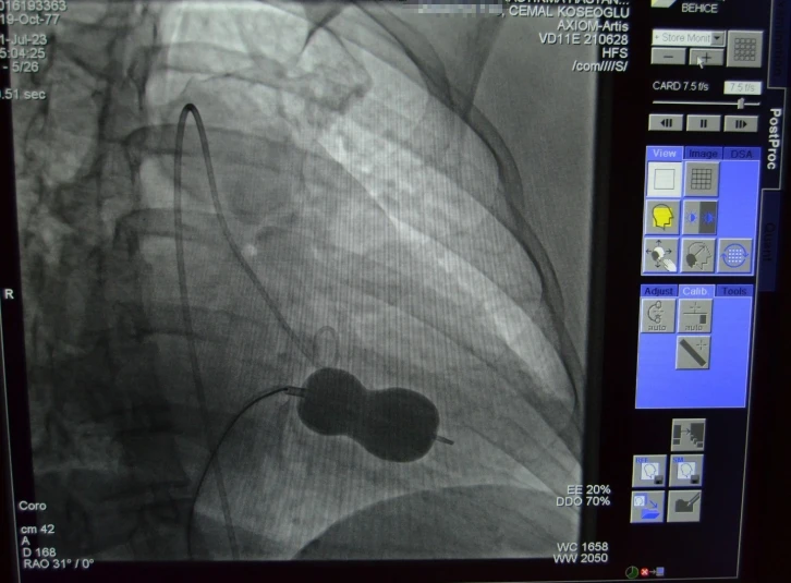 Alanya’da mitral kapak darlığı ameliyatsız tedavi edildi
