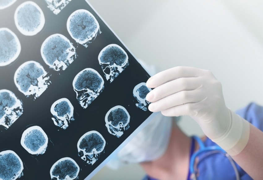 Glioblastoma nedir?