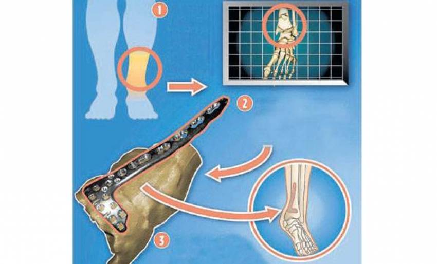 Kırılan kemiğe 3D onarım