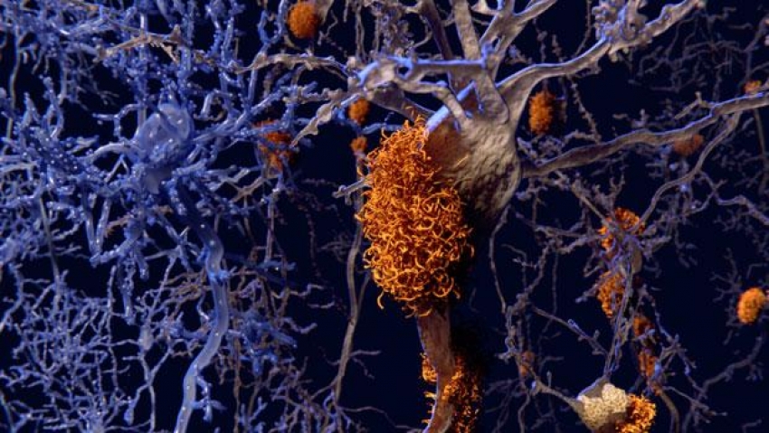 Alzheimer'ı temizleyen molekül bulundu