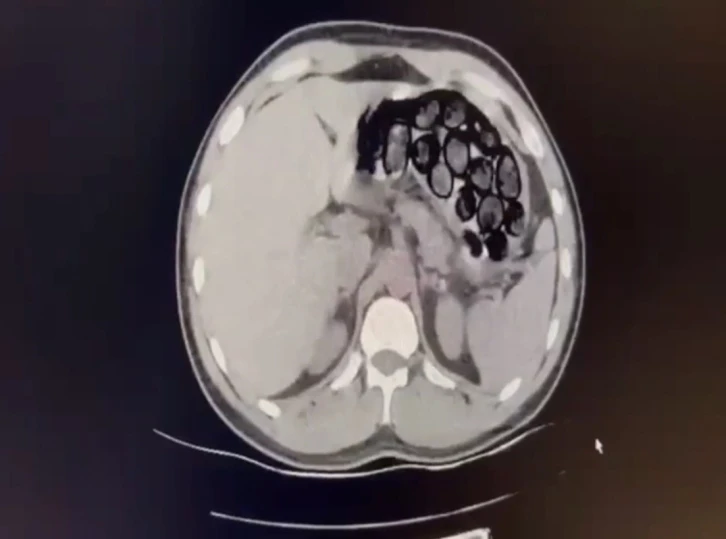 Mide ve bağırsağından 65 kapsül uyuşturucu çıktı
